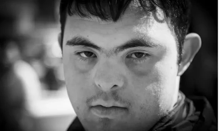 Yapon alimlər Daun sindromunun müalicəsini tapıblar